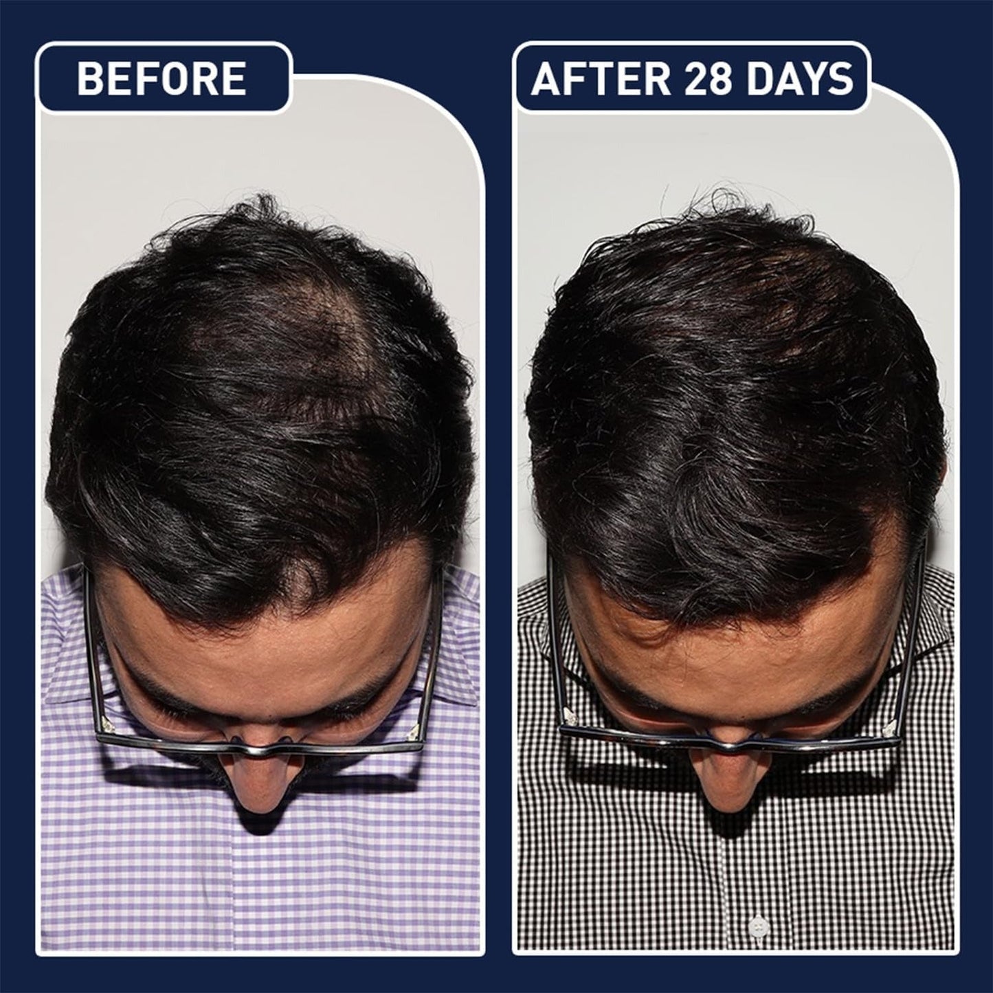 سيروم مينوكسيديل FEGPlus لنمو اللحية والشعر