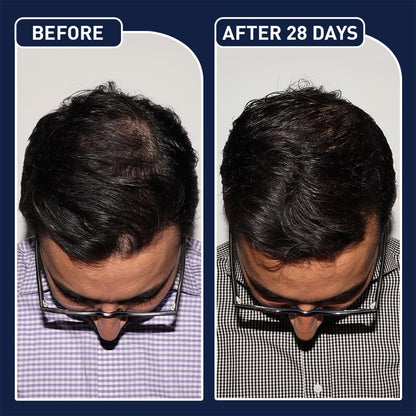 سيروم مينوكسيديل FEGPlus لنمو اللحية والشعر